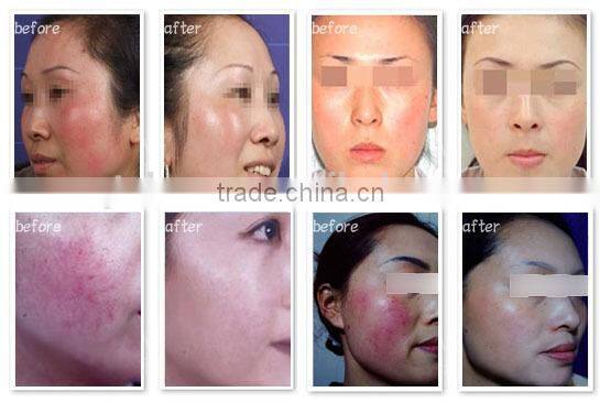 Body Care Tria Hair Removal Opt Shr Device