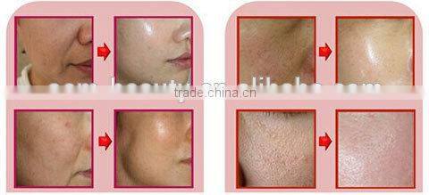 Multi-function beauty facial skin massage machine for wrinkle removal, face lifting -JTLH-1602