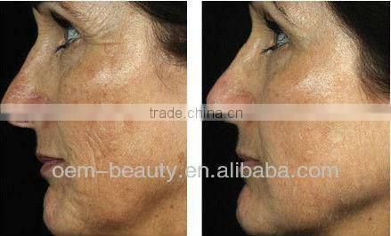 Best cooling system elight ipl rf nd yag laser system