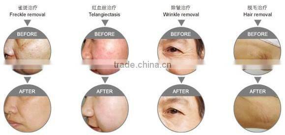 China Manufacture ipl laser hair removal machine for sale-F8