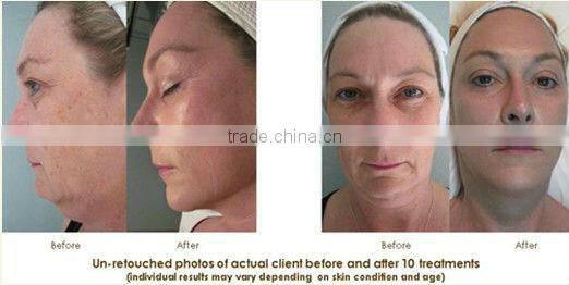 12/9 pin needles cartridge tip for mirco needle electric auto derma stamp pen