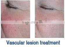 IPL machine for hair removal, freckle removal with Memory battery in the handpiece-(FB-A006)