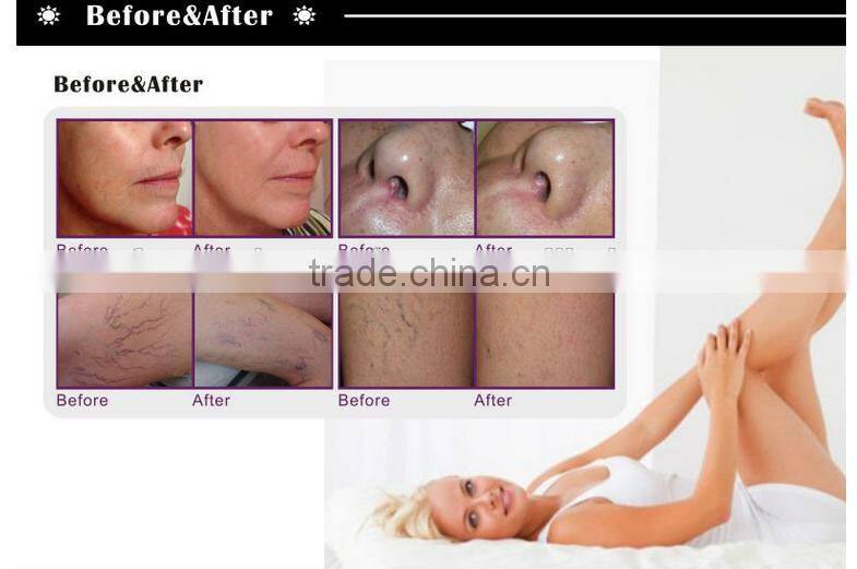 RF vein removal machines-RBS100 promotion price on sale (price same as boxing day price)