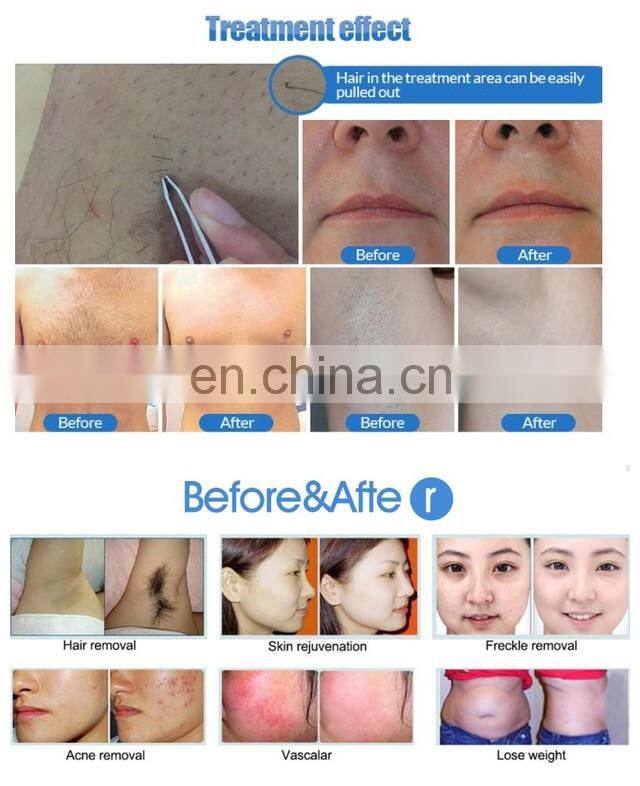 Hot sale 808nm laser diode hair removal machine 800nm laser diode with CE