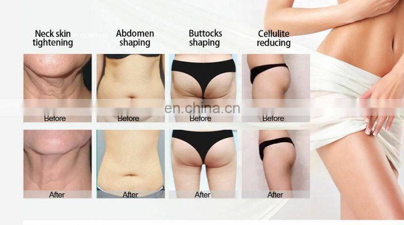 MLKJ Cavitation + RF + Infrared+Cavitation 40 khz+Cavitation Slimming Machine