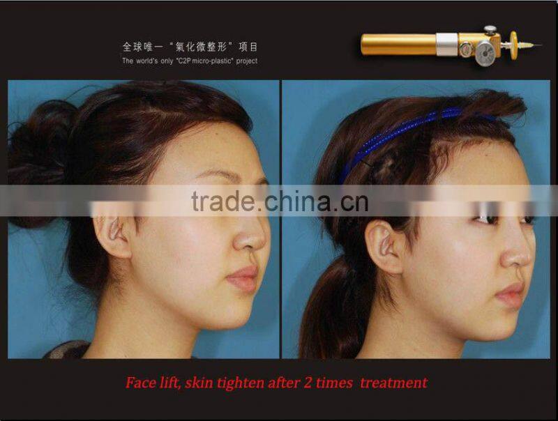 fast beauty device!!!CDT CO2 carboxy equipment/carboxy therapy machine