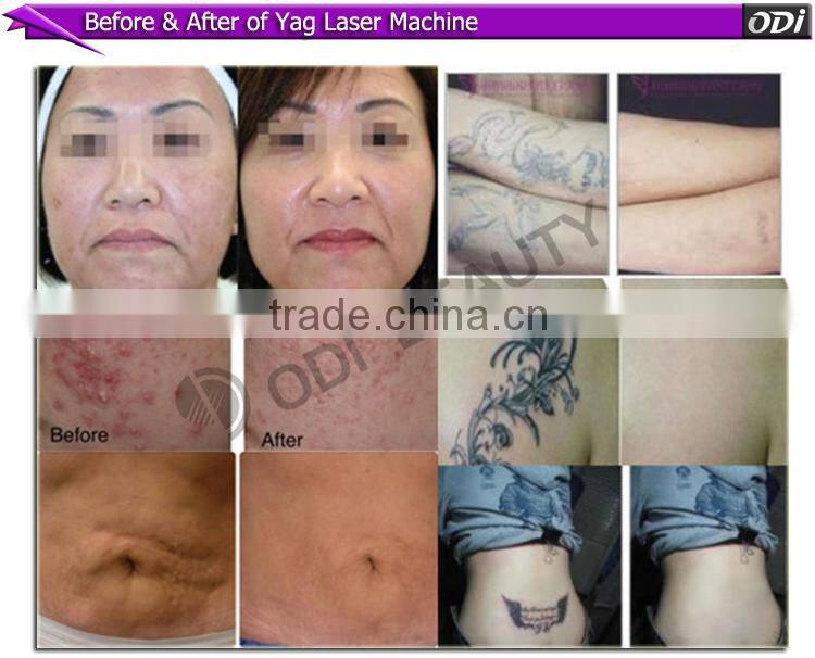 Medical CE! Quick freckle remover feature EO Active YAG Q-switch laser