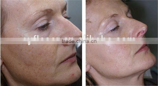 popular Almighty Oxygen Jet for Beauty Salon