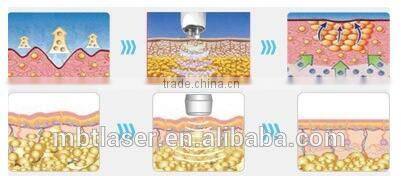 summer use fat removal and face treatment radio frequency machine wrinkle removal and face lift