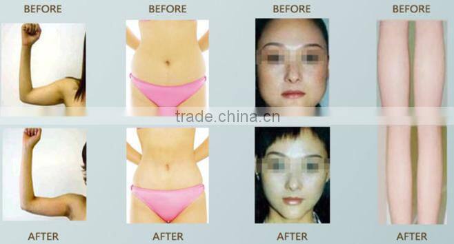 4 different handle cavitation vacuum cavitation rf slimming multifunction machine for wrinkle removal