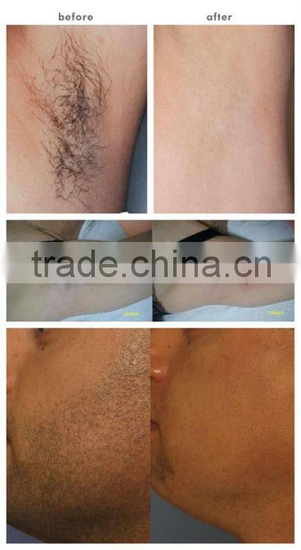 laser hair removal beauty machine /nail fungus P003