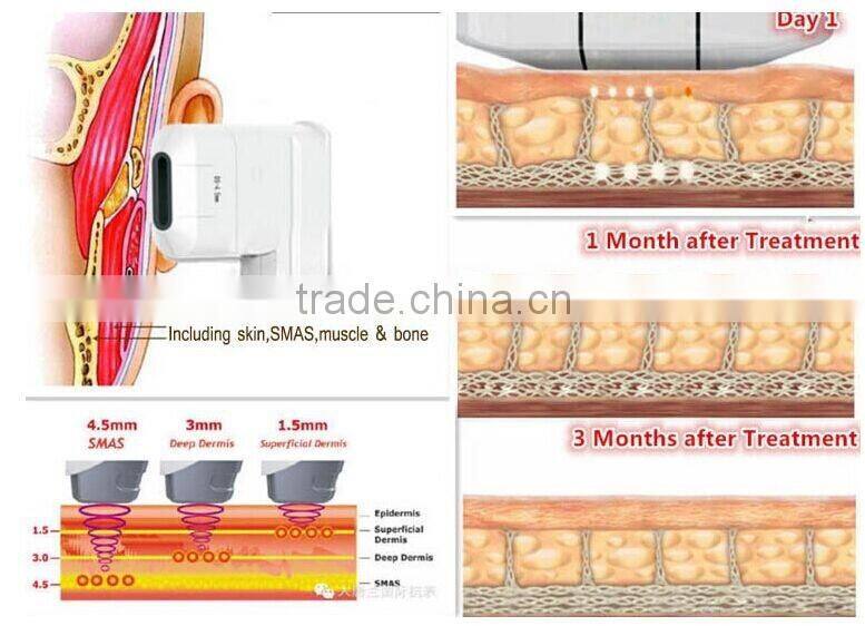 Hot hifu with medical CE