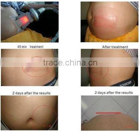 Promotion!!! CE approved newest cryo lipolysis body slimming devices