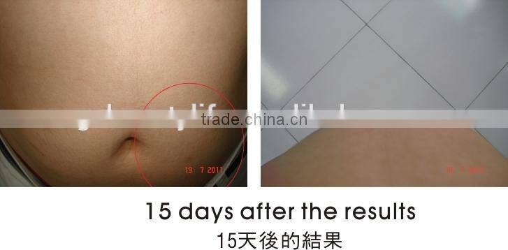 Cool tech lipo freeze machine weight loss/non-invasive liposuction device