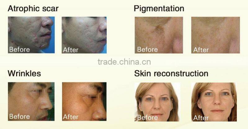 Guangzhou HETA Fast cavitation slimming system pigment removal machine