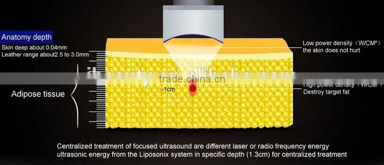 2016 New technology hifu slimming machine / lipo hifu machine