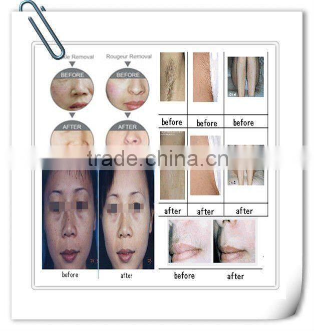 E5B new style ipl rf e-light 2 handles Super vertical hair removal