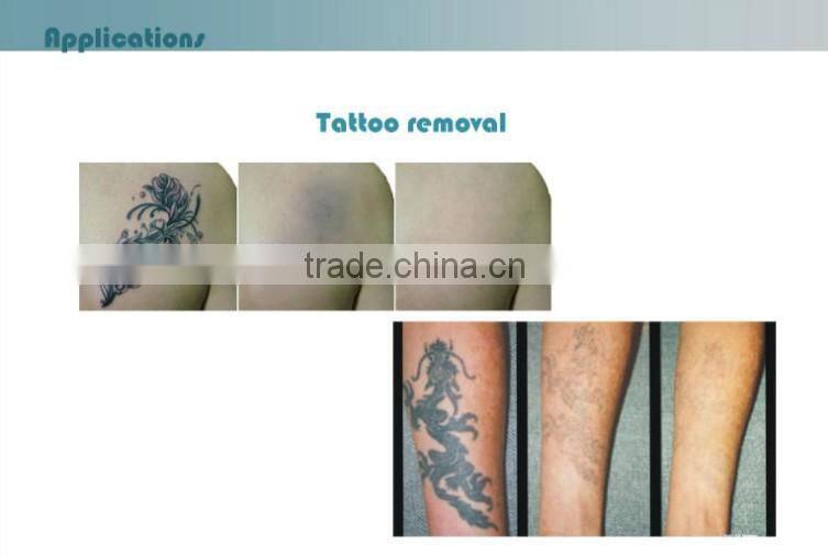 high quality q switch nd yag laser device for effective tattoo removal