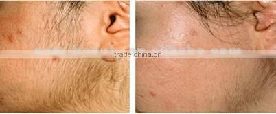 2016 hot selling permanent hair removal beauty equipment IPL machine for skin rejuvenation anti aging wrinkle removal