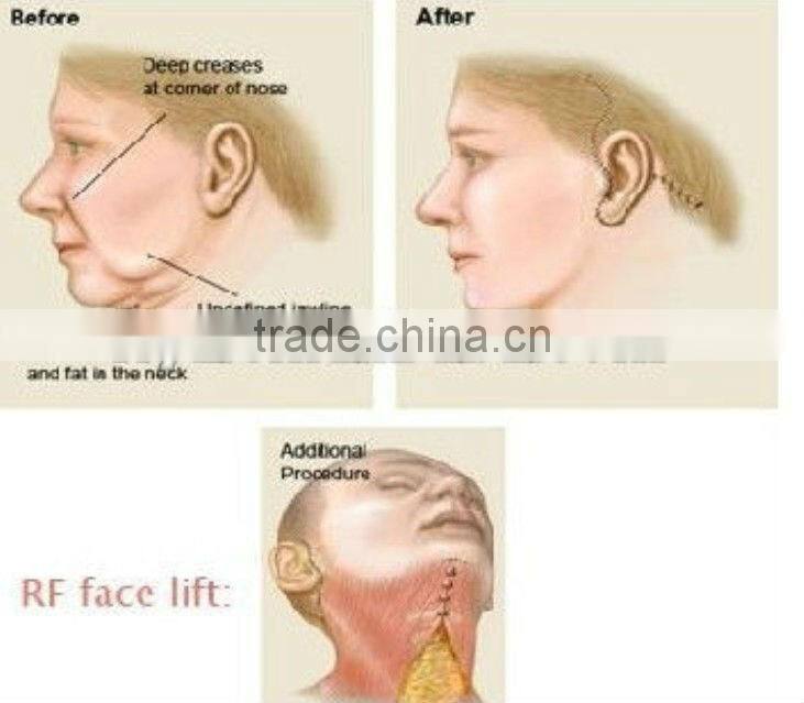 VY-QF8 Popular radio frequency facial machine for skin tightening