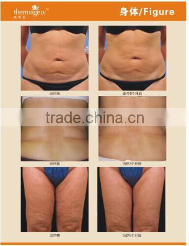 rf beauty machine rf equipment rf home use face lift devices AYJ-T28 CE