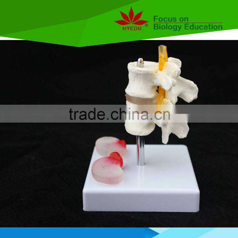 High quality for medical educational supply 2 lumbar vertebrae skeleton model with hernia and prolapsed intervertebral disc