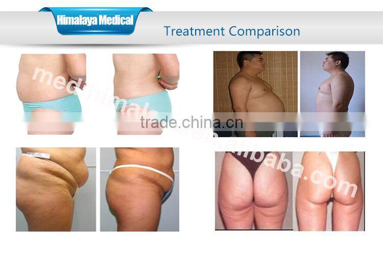 great silicone handle cool tech fat freezing machine