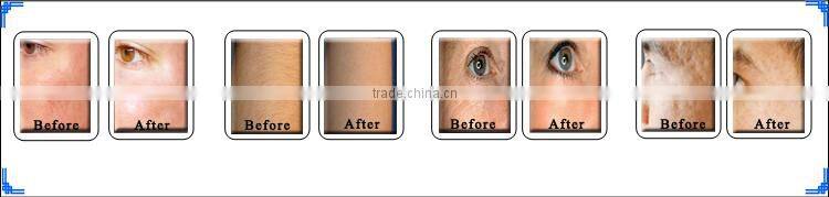 vertical type SHR/ IPL beauty machine, IPL hair removal machine