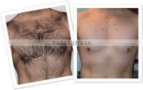 High quality and low price! Professional diode laser/808nm diode laser/laser hair removal for permanent hair removal