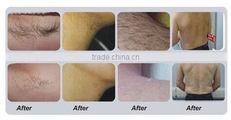 Powerful 900w 808nm diode hair removal machine