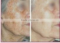 Q switch nd yag laser skin age spot removal machine