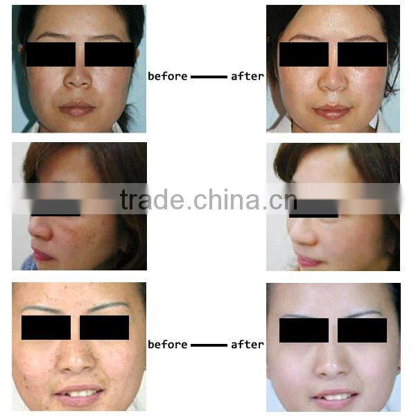 Cheap portable laser machine part balck dool for pigment removal