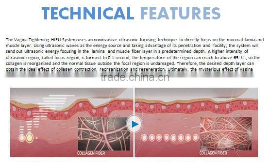 2016 hot selling ultrasonic Hifu vaginal tightening machine