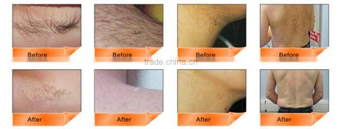 Vertical IPL SHR OPT Beauty Machine for Hair Removal Skin Rejuvenation