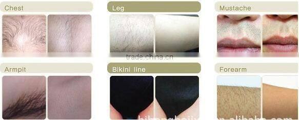 2016 latest painless shr elight ipl hair removal machine