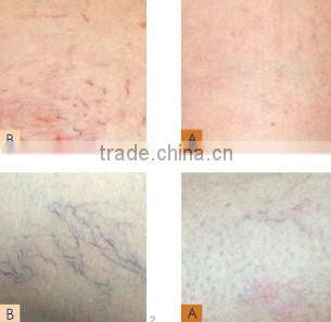 Best painless RBS 30MHz high frequency machine vascular lesions for spa use