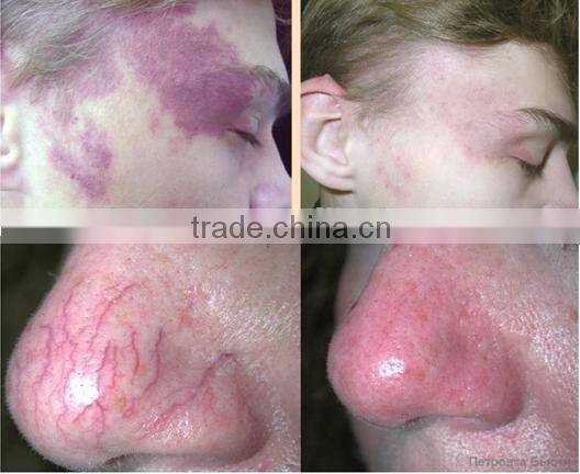 980nm spider vein removal machine vascular remover diode laser machine portable vascular doppler