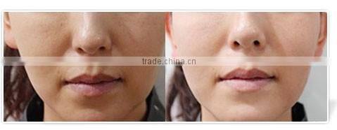 mesotherapy gun skin whitening facial care mesogun injector