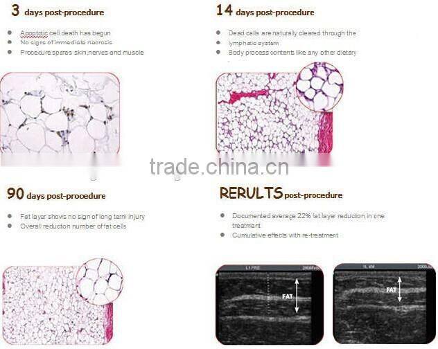 High quality cryotherapy price cryolipolysis freezing machine