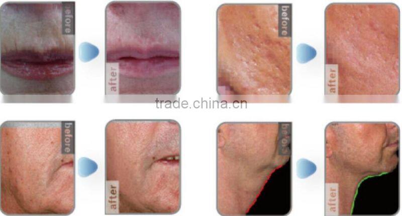 New shr ipl equipment for distributor Vertical IPL SHR&E-light hair removal equipment&machine