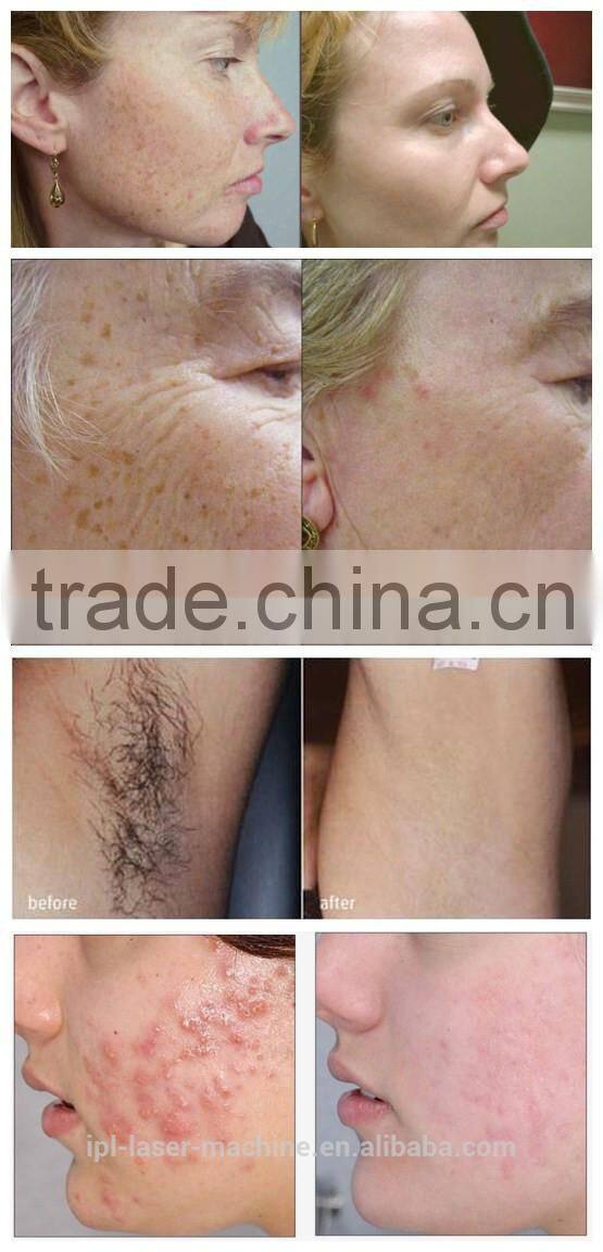 2016 Professional IPL SHR, ipl shr handpieces, ipl shr hair removal machine