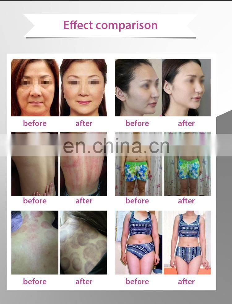 Multiple Slimming Technology Cavitation + Vacuum + Multipolar RF + Ultrasound Fat Reduction Weight Loss Machine