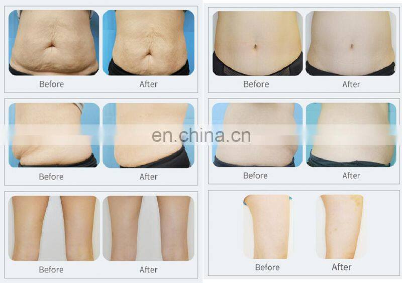 Korea technology Professional cryo pad Machine Mini Cryo fat freeze Portable body slimming body shaping Machine