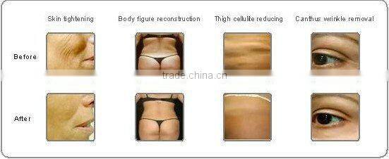 New Products 2014 Laser IPL hair Removal Machine