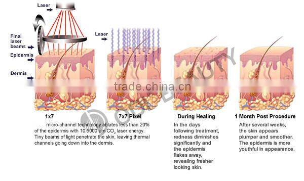 Bestsellers fractional laser co2 vaginal equipment