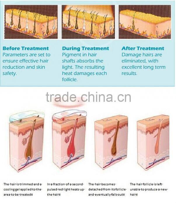 Mini Home IPL Hair Removal Machine/ Best SHR Elight IPL RF Skin Rejuvenation Beauty Equipment