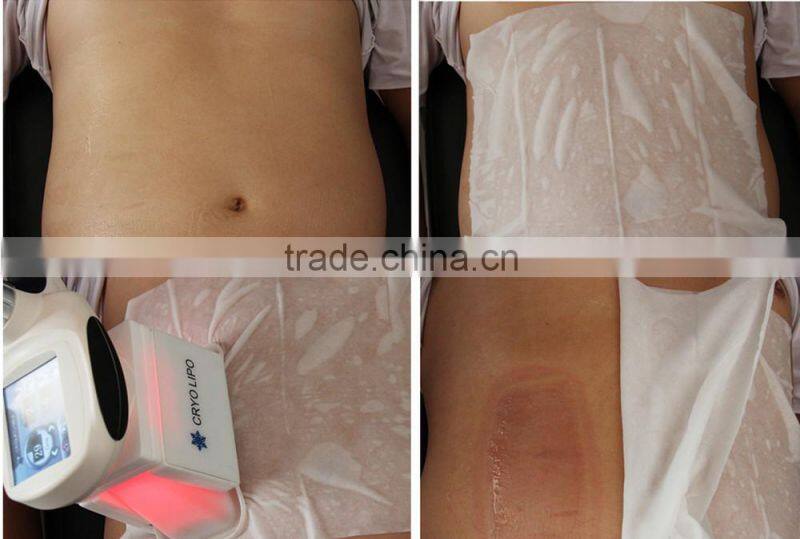 Distributors Opportunity / Frozen Lipo Cooling Fat / Remove Abdomen Slim Cryotherapy-Machine