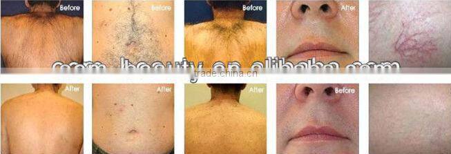 Elight ipl hair removal machine for sale C001