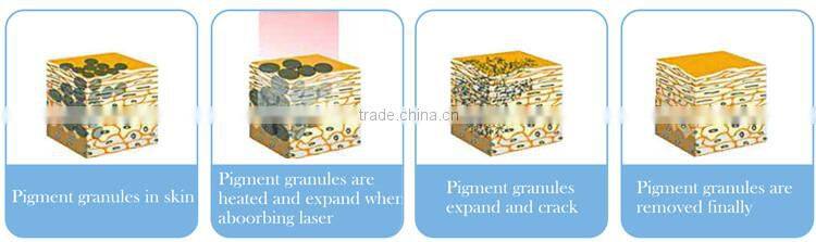 ce approved painless 1320nm 1064 nm 532nm gentle long pulse pigments tattoo removal varicose veins laser treatment q switch nd