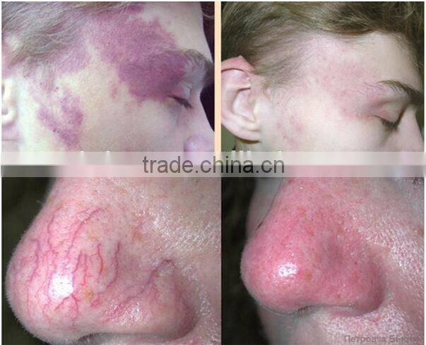 Hot sale 980nm vascular remover laser vein removal machine for sale